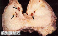 前列腺結石