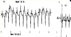 心房內折返性心動過速