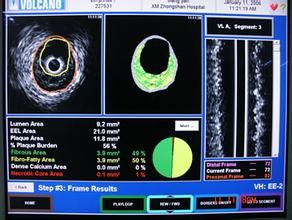 異染性腦白質退化症 異染性腦白質退化症