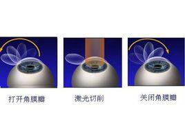 PRK手術 PRK手術