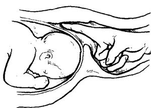 人工剝膜術 人工剝膜術