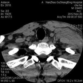 非何杰金氏淋巴瘤 非何杰金氏淋巴瘤