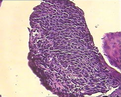 會陰濕疣 會陰濕疣