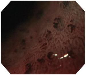 門脈高壓性胃病 門脈高壓性胃病