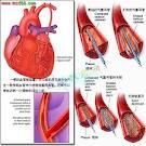 經皮冠狀動脈介入