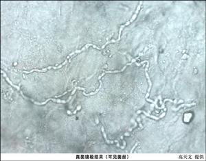 病毒性腦膜腦炎