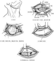 咽部神經鞘膜瘤 咽部神經鞘膜瘤