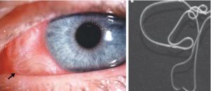 結膜下匐行惡絲蟲感染