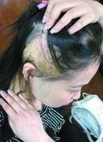 女性斑禿 女性斑禿