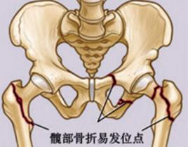髖部 髖部