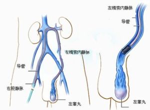 精索靜脈曲張