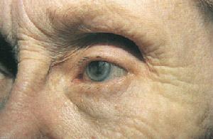 淺層點狀角膜炎