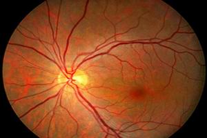 糖尿病性視網膜病