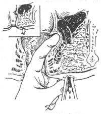 直腸外傷 直腸外傷