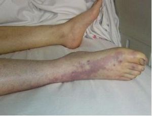 周圍血管征 周圍血管征