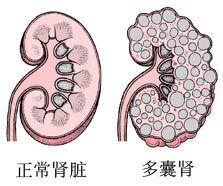 腎前性腎功能衰竭 腎前性腎功能衰竭