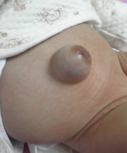 嬰兒臍疝 嬰兒臍疝