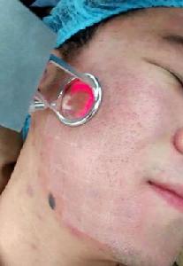 雷射祛痘印 雷射祛痘印