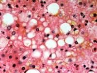 硬化性脂肪肉芽腫