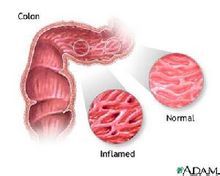 慢性結腸炎圖解