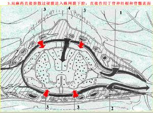 結核性脊髓炎 結核性脊髓炎