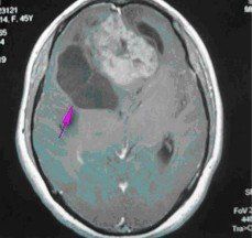 惡性膠質瘤 惡性膠質瘤