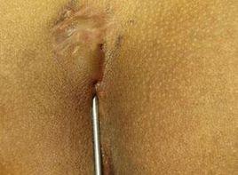 骶尾部竇道形成 骶尾部竇道形成