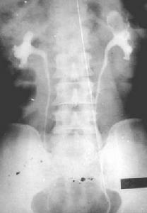 腎盂腫瘤和輸尿管腫瘤