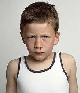 習慣性流鼻血 習慣性流鼻血