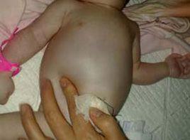 新生兒全身水腫 新生兒全身水腫