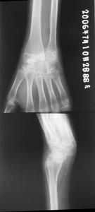 幼年性類風濕性關節炎