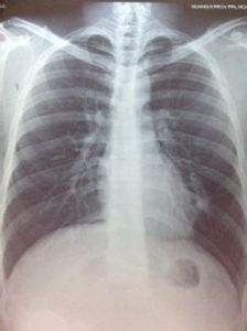 肺部陰影 肺部陰影