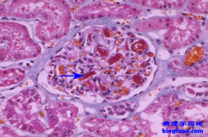 彌散性血管內凝血
