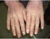 牛皮癬關節炎 牛皮癬關節炎