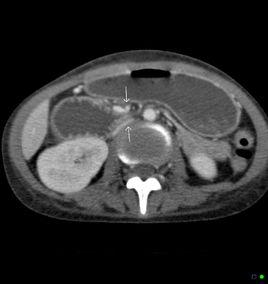十二指腸血管性壓迫綜合徵 十二指腸血管性壓迫綜合徵