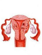 子宮附屬檔案炎 子宮附屬檔案炎