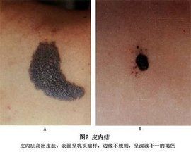 皮內痣 皮內痣
