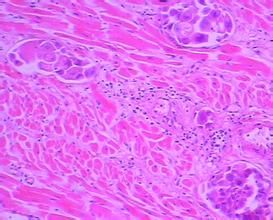 大細胞未分化癌 大細胞未分化癌