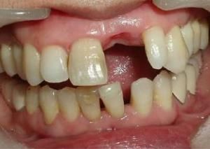 牙齒鬆動 牙齒鬆動