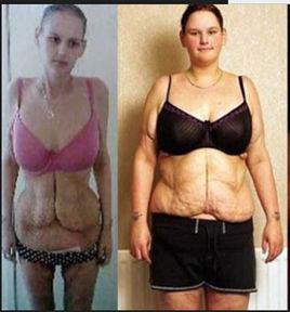 瘦身後遺症 瘦身後遺症