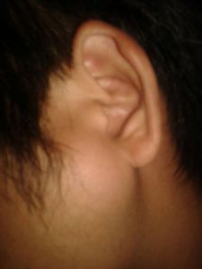 多形性腺瘤 多形性腺瘤