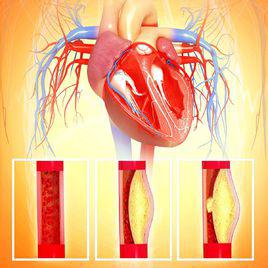 主動脈粥樣硬化 主動脈粥樣硬化