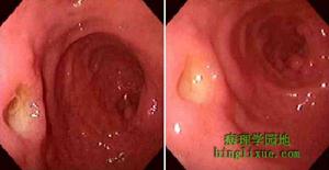 十二指腸胃反流