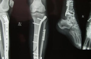 骨筋膜室綜合症 骨筋膜室綜合症