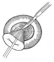 宮頸錐切 宮頸錐切