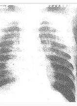 細菌性肺炎 細菌性肺炎