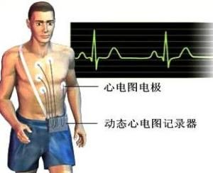 24小時動態心電圖 24小時動態心電圖
