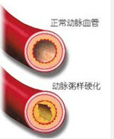 血管硬化