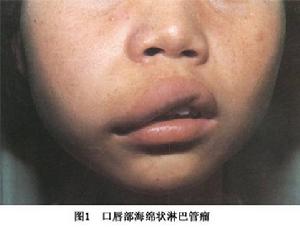 （圖）海綿狀淋巴管瘤