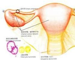 急性盆腔炎 急性盆腔炎